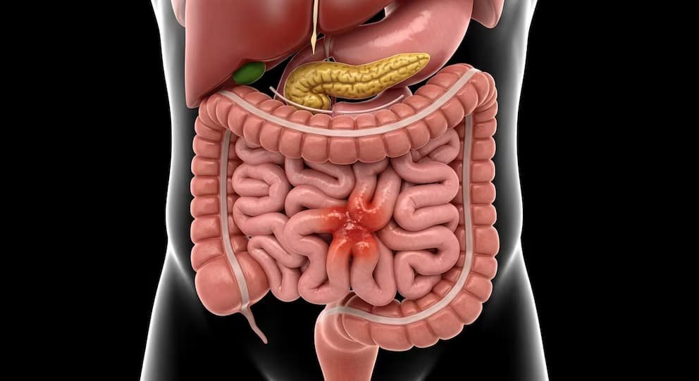 Los nuevos criterios amplían el diagnóstico del intestino irritable